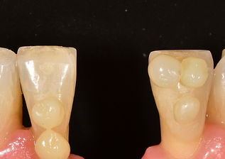 Caso clínico - espacio edéntulo anterior