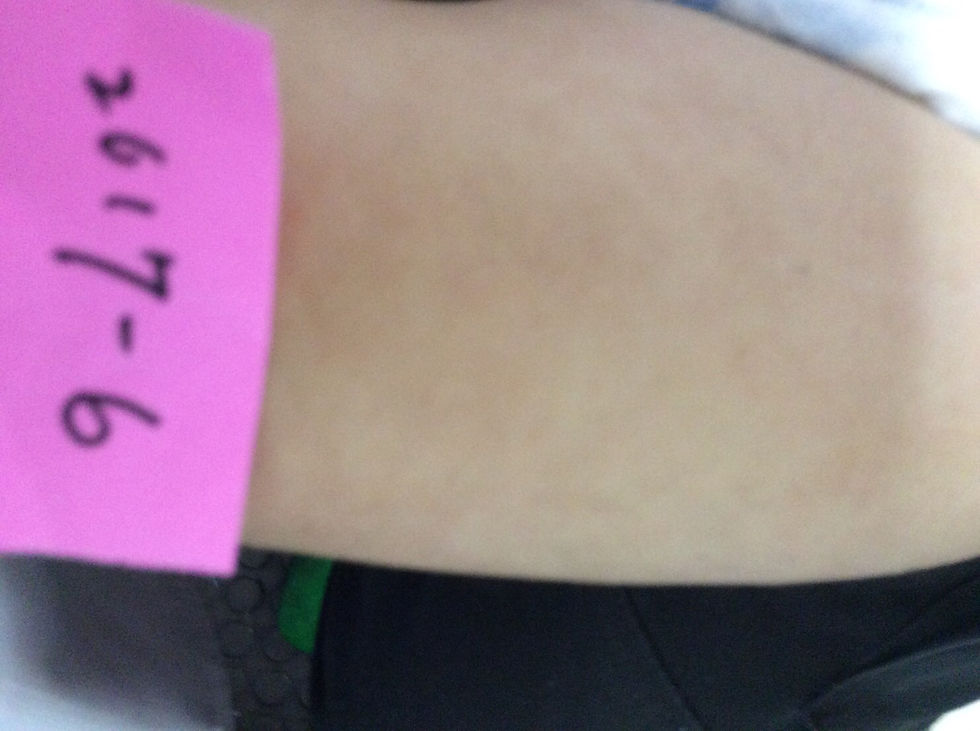 小児アトピー性皮膚炎　回復