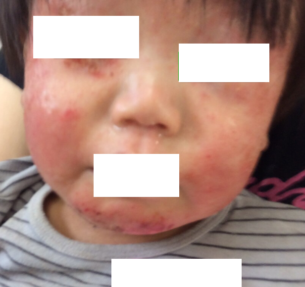 ツルツルすべすべに 小児アトピー性皮膚炎から