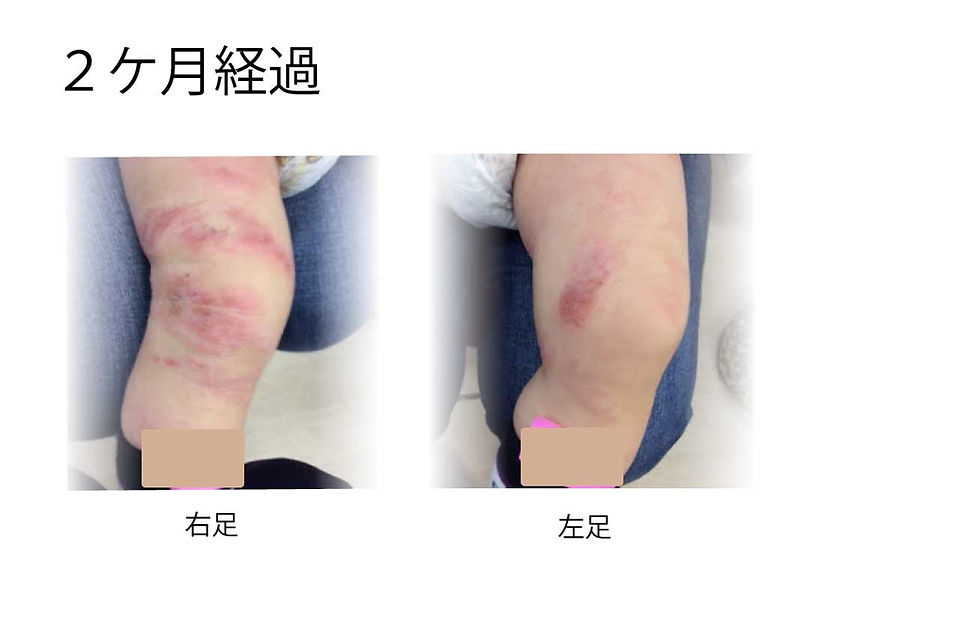 小児アトピー性皮膚炎治療　２ケ月経過