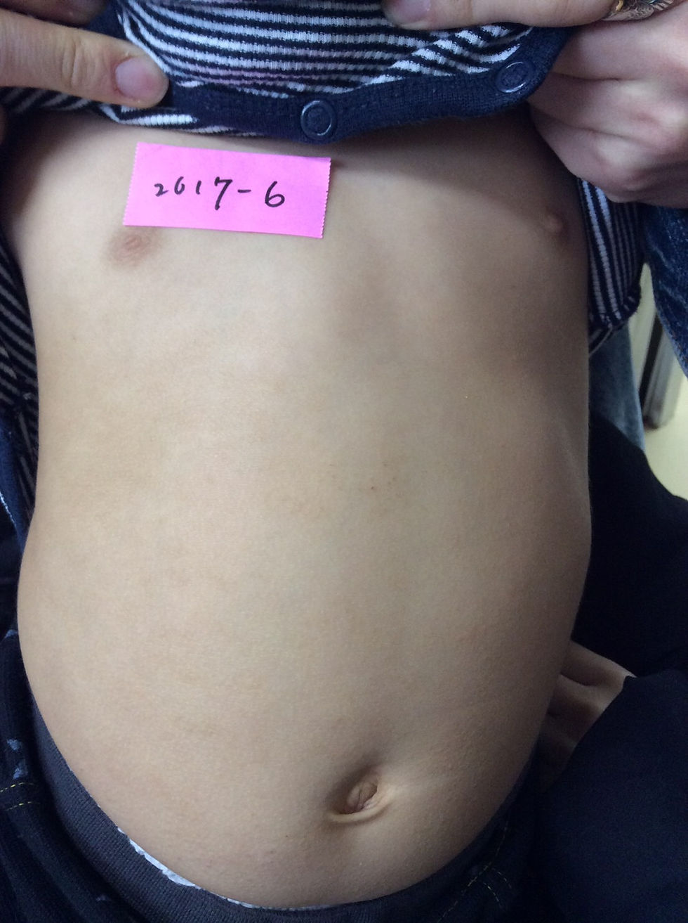 小児アトピー性皮膚炎