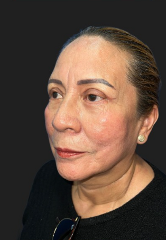 blefaroplastia D.png