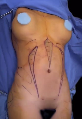 lipoescultura secundaria A.png