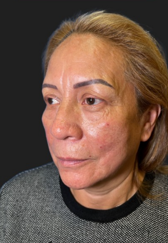blefaroplastia A.png