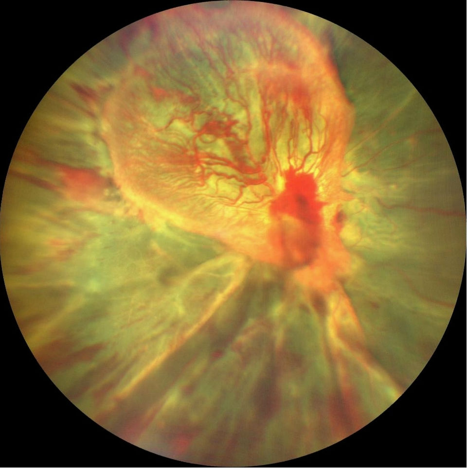 Tractional retinal detachment