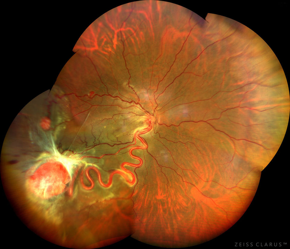 Multifocal Retinal Capillary Hemangioblastoma with Tractional Retinal Detachment