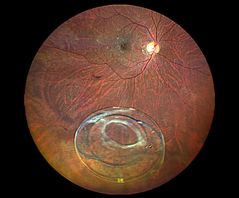 Dislocated iol bag complex with CTR in vitreous cavity