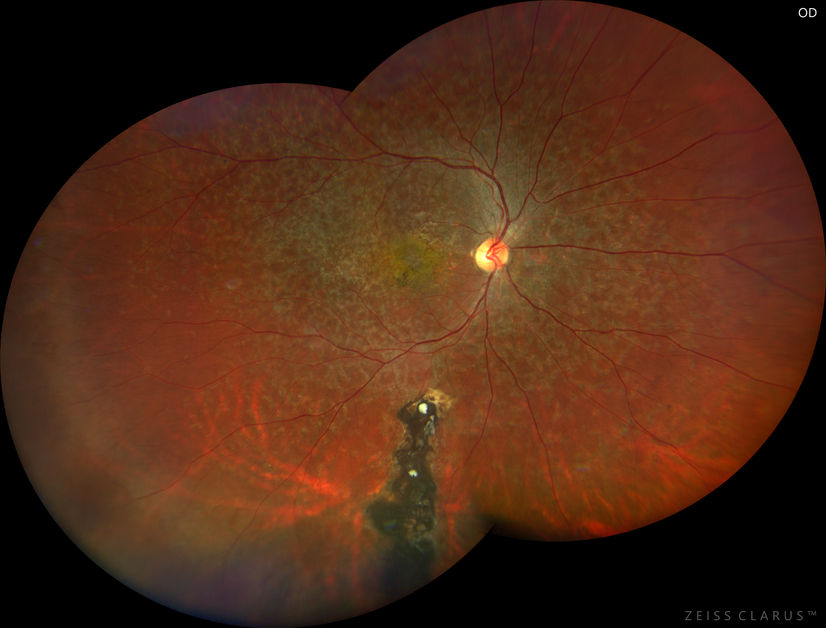 Spot that yellow flecks in the eye