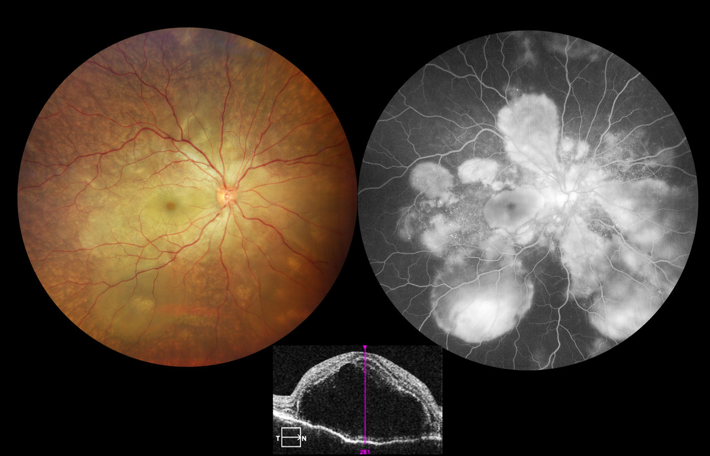 Vogt-Koyanagi-Harada Disease