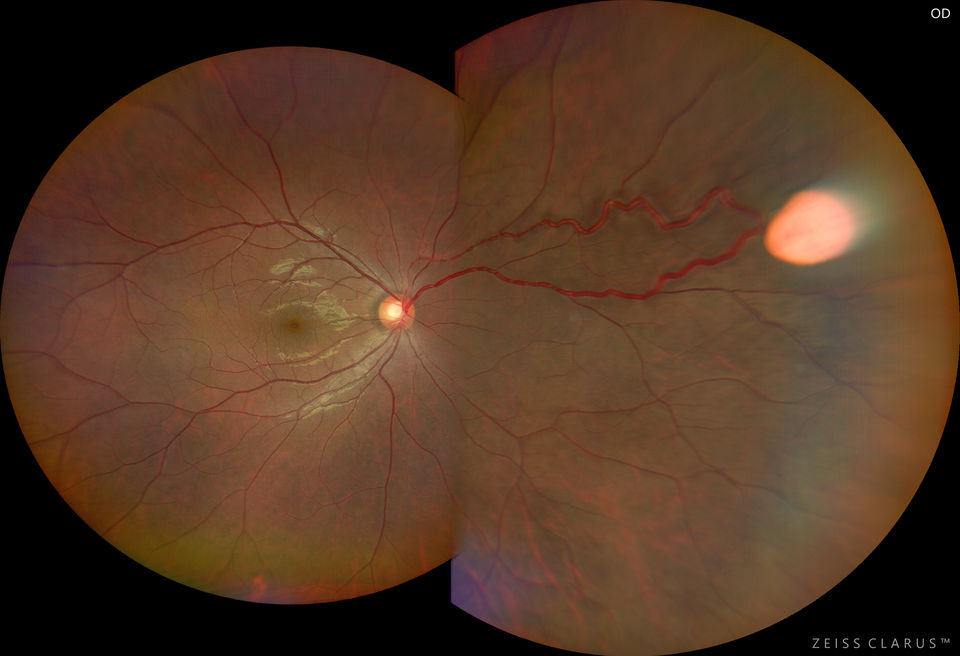 VHL with R nasal capillary haemangioma