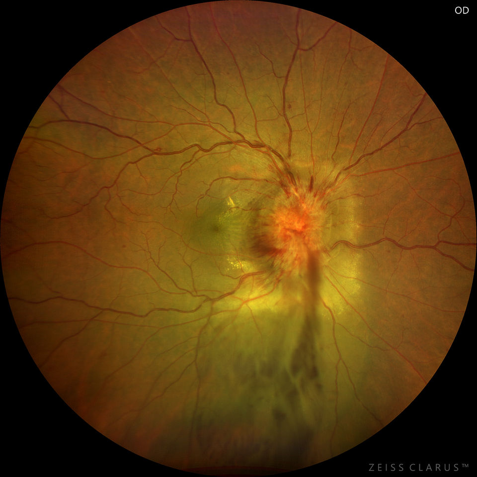 Severe unilateral disc swelling