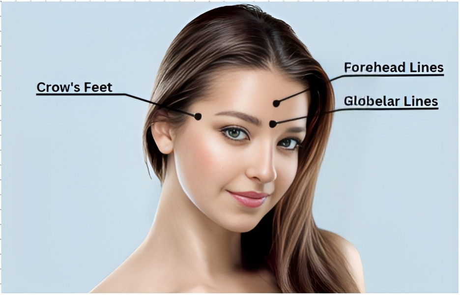 botox toronto