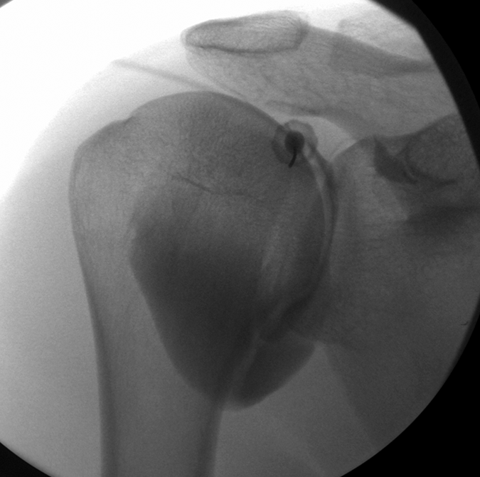 Arthrogram of the shoulder 