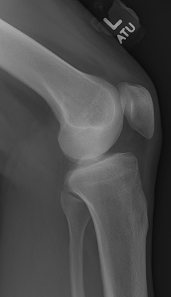 M_KNEE_20150626_163722_edited