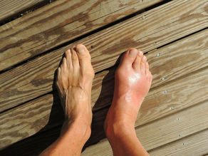Understanding Gout with TCM