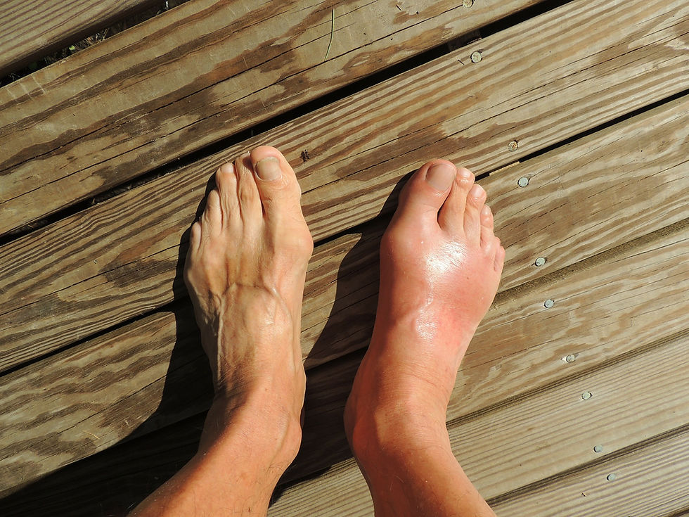 acute gout attack