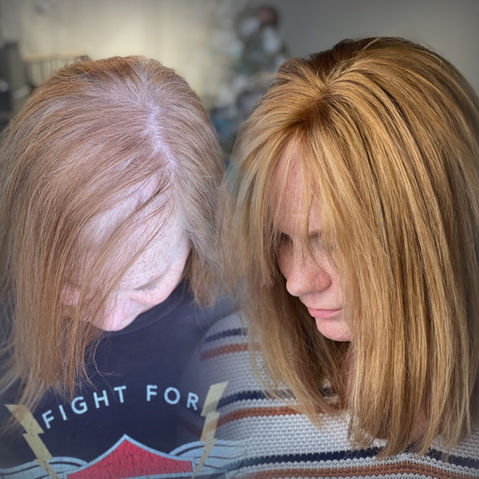 hair loss solutions Dallas