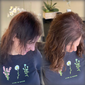 hair loss solutions Dallas