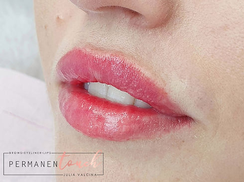dermal lip fillers therford.jpeg