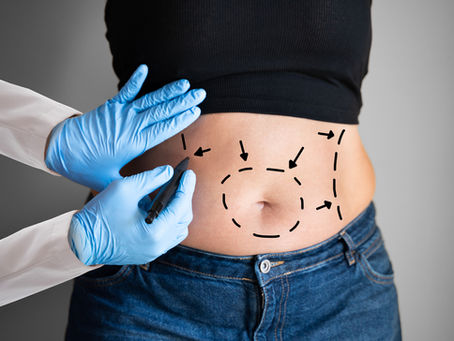 Best Liposuction Results and Costs in Buckeye