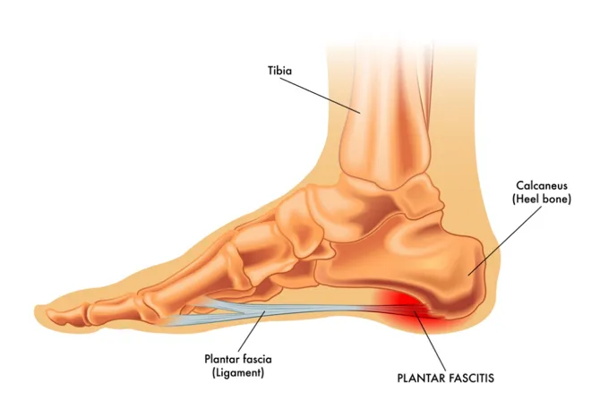 plantar-fasciitis.webp