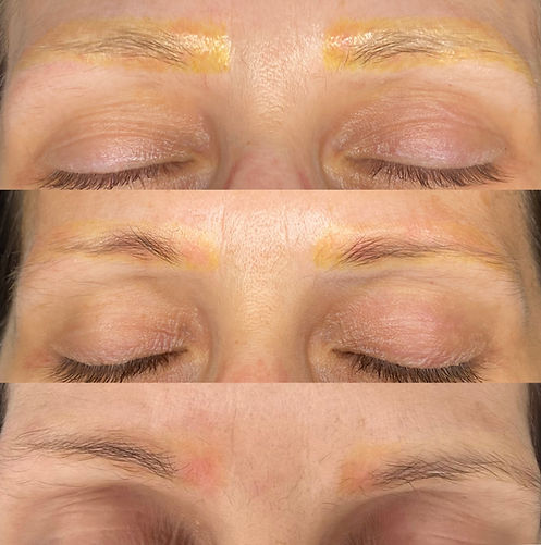 Vorher Nachher Yellow Pigment Removal