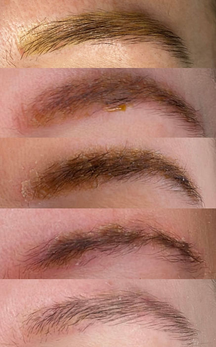 Heilungsprozess Yellow Pigment Removal