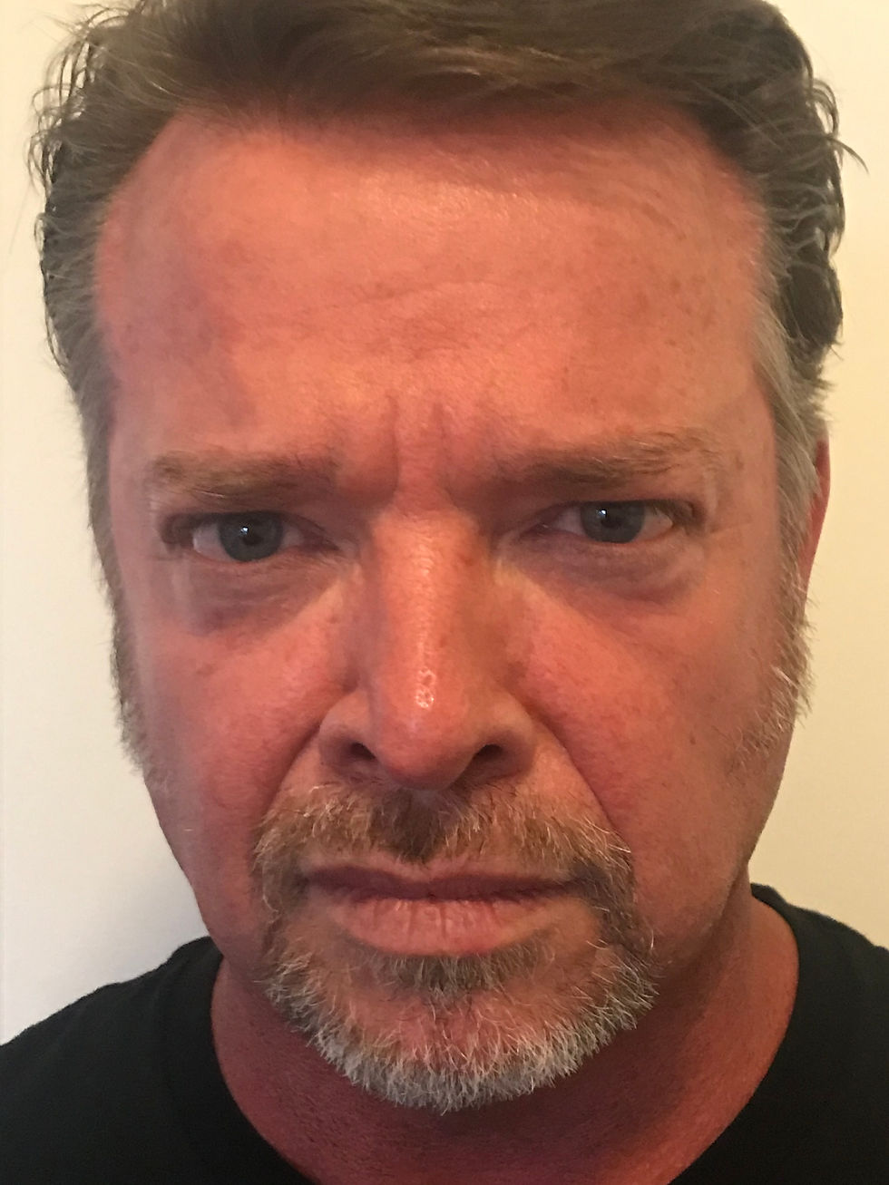 Glabella After w Movement
