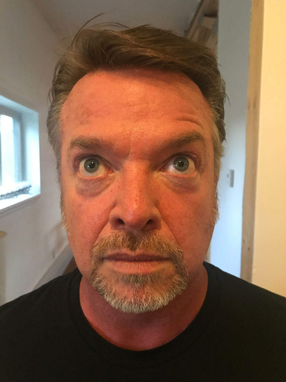 2. Forehead - After w Movement