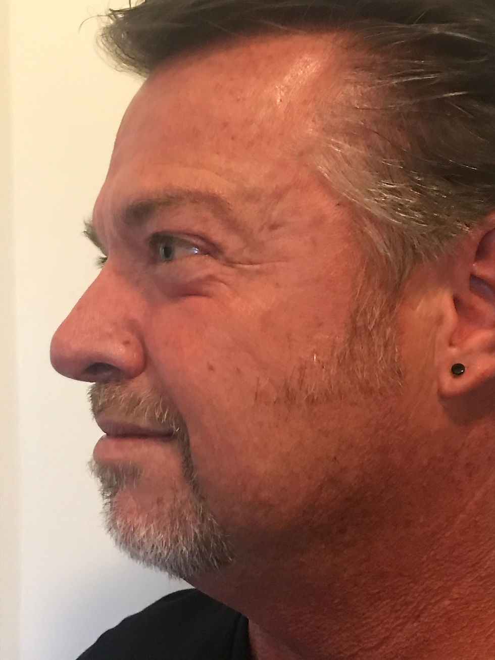 Left Crows Feet After w Movement