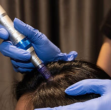 Microneedling therapy.jpg