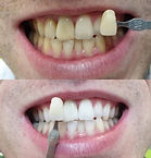 clareamento dental