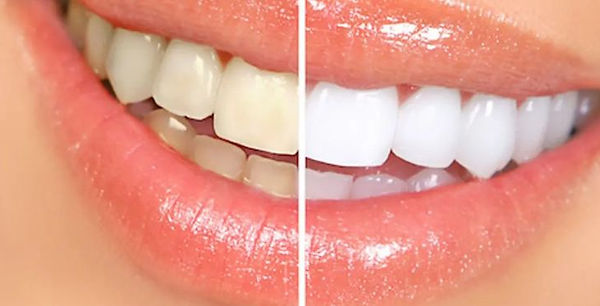 clareamento dental