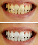 clareamento dental