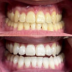 clareamento dental