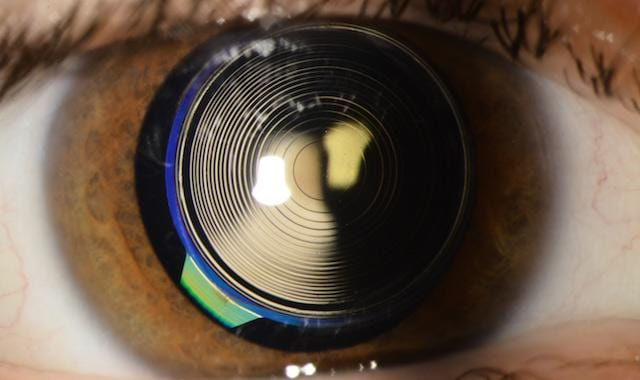 multifocal_lens_implant.jpg