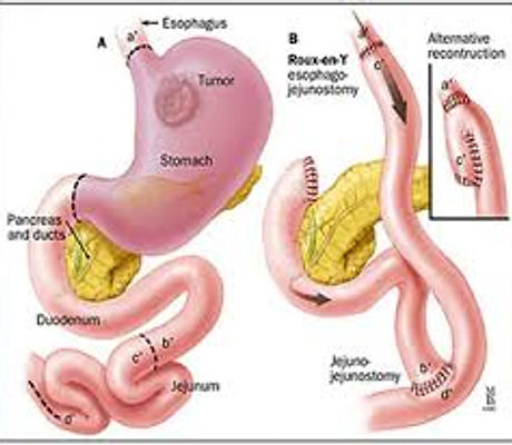 gastrectomie tot.jpg