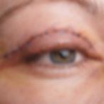 blepharoplasty-surgery-recovery-scaled-1_edited.jpg