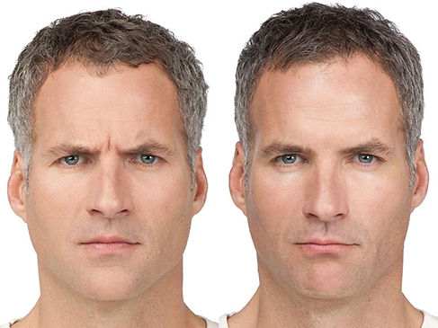 botox-cosmetic-11-front-detail.jpeg