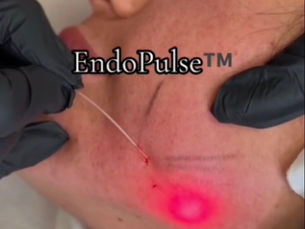 Endo Laser Skin Tightening in Tamworth: The Non-Surgical Lift Without Surgery