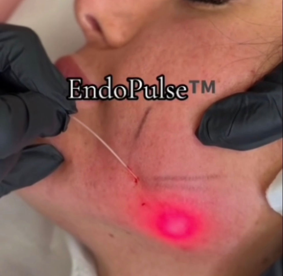 Endo Laser Skin Tightening in Tamworth: The Non-Surgical Lift Without Surgery