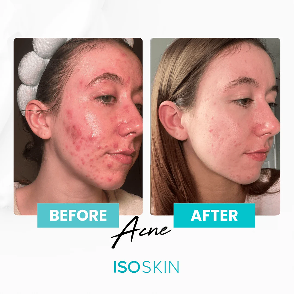 Thumbnail: Isoclean Hypochlorous Acid Spray Isoskin 525 ml