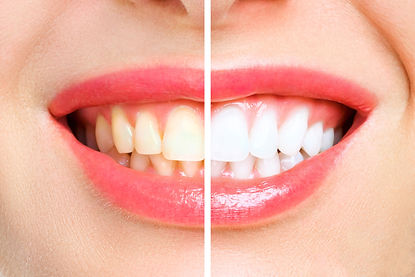 woman-teeth-before-after-whitening-image