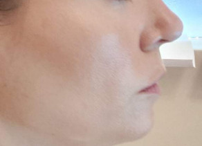 TBN: Double Chin Edition- Aqualyx Treatment Review
