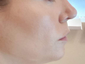 TBN: Double Chin Edition- Aqualyx Treatment Review
