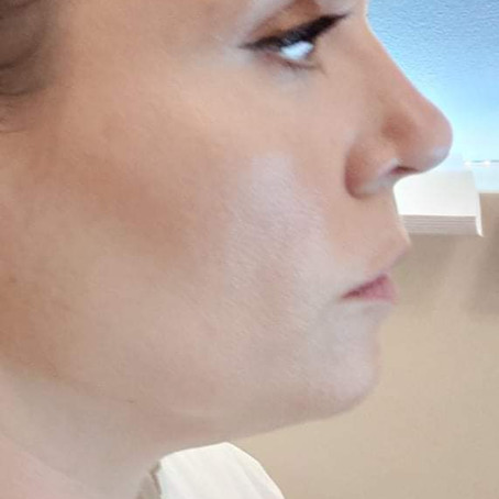 TBN: Double Chin Edition- Aqualyx Treatment Review