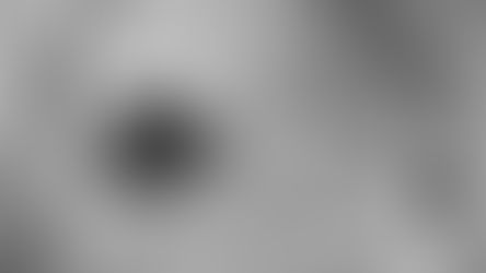 एन्युक्लिएशन | Enucleation