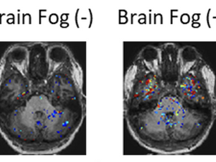 Trinity team discovers underlying cause of “brain fog” linked with Long COVID