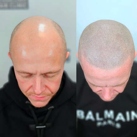 scalp micro result for a 30 something guy from fife, scotland