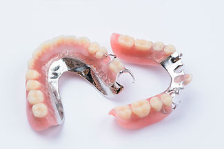 Removable metal partial denture